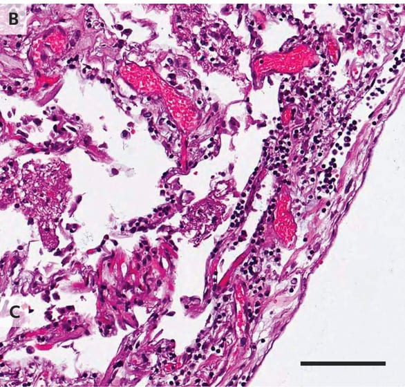 Những phát hiện bất ngờ từ phổi bệnh nhân COVID-19 - Ảnh 3.