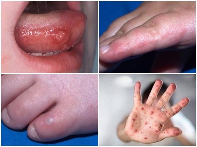 Hình ảnh một số triệu chứng của bệnh tay chân miệng /// Ảnh: Tư liệu BV Nhi T.Ư