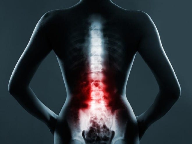 Viêm khớp cột sống gây những cơn đau dọc theo cột sống, mức độ đau sẽ ngày càng tăng /// Ảnh minh họa: Shutterstock