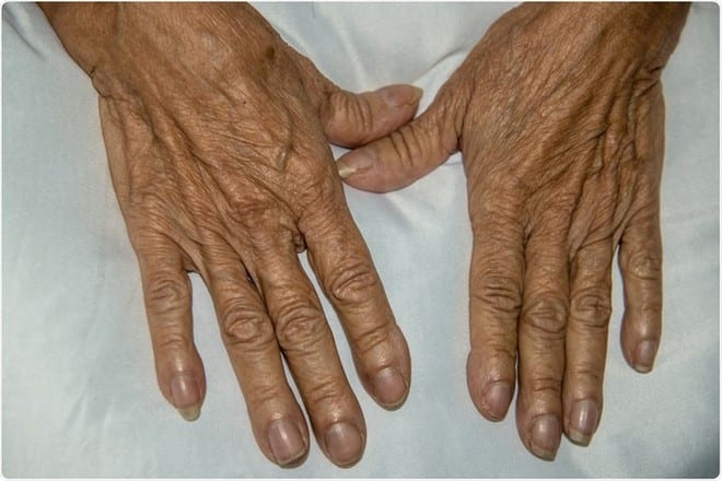 Quan sát móng tay có thể phát hiện dấu hiệu bệnh sớm /// Ảnh minh họa: Shutterstock