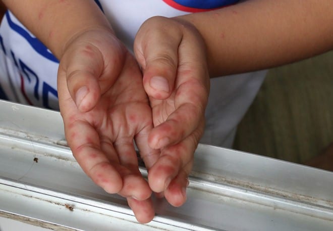 Trẻ bị tay chân miệng có dấu hiệu đặc trưng nổi các mẩn đỏ trên bàn tay /// Nguyên Mi