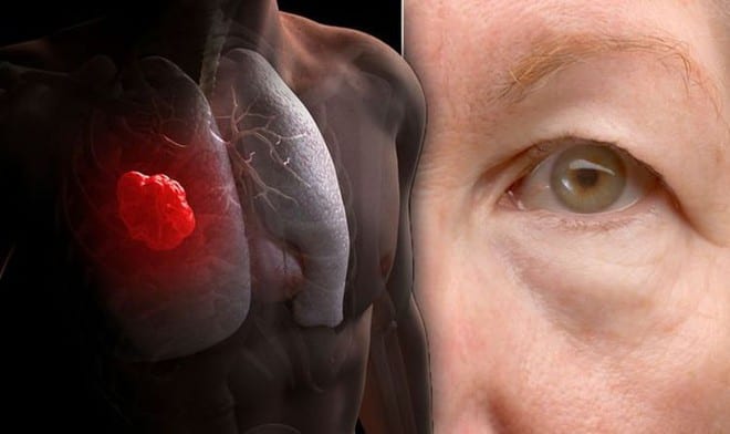 Một dấu hiệu đáng ngạc nhiên báo hiệu ung thư phổi là đồng tử ở một mắt nhỏ hơn /// Ảnh minh họa: Shutterstock