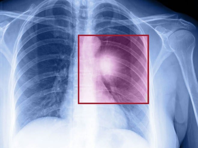 Ung thư phổi thường không gây ra các triệu chứng cho đến khi bệnh đã tiến triển /// Ảnh minh họa: Shutterstock 