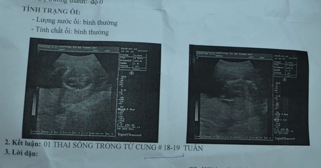 Ngành y tế TP.HCM từng phát hiện một số trường hợp phá thai "chui" khi tuổi thai đã lớn /// Ảnh minh họa: Duy Tính