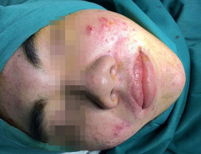 Khuôn mặt bệnh nhân bị đơ sau khi tiêm silicon /// ẢNH: BVCC