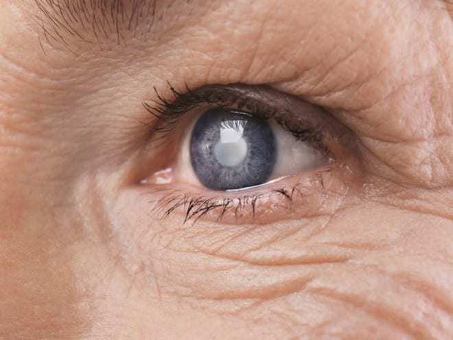 Suy giảm thị lực là dấu hiệu đầu tiên của đục thủy tinh thể /// Ảnh minh họa: Shutterstock