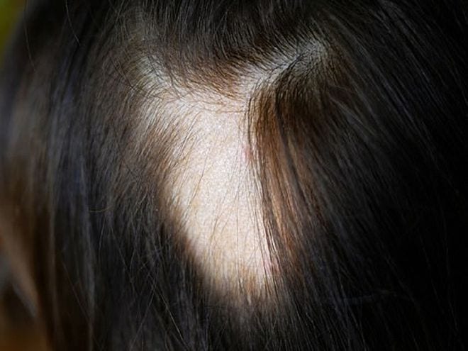 Các nhà khoa học phát hiện Covid-19 có liên quan đến chứng rụng tóc alopecia areata, tình trạng mà tóc rụng ra thành từng mảng /// Ảnh minh họa: Shutterstock