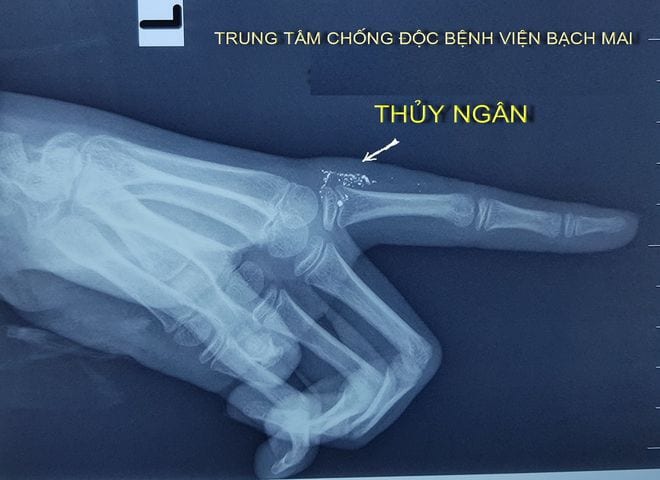 Chụp X-quang xác định các hạt thủy ngân nằm sâu gần các khớp ngón tay /// Ảnh: Mai Thanh