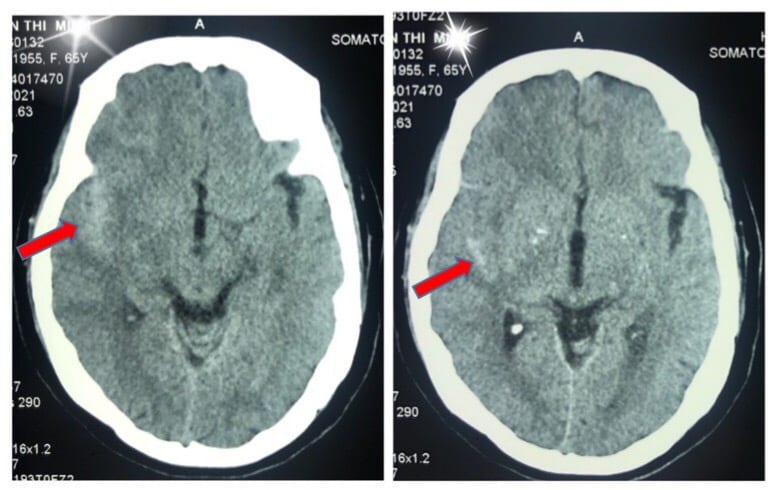 Hình ảnh phim CTscan sọ não của BN M. cho thấy các vị trí (mũi tên) bị xuất huyết trong não /// ẢNH: ĐẶNG SƠN
