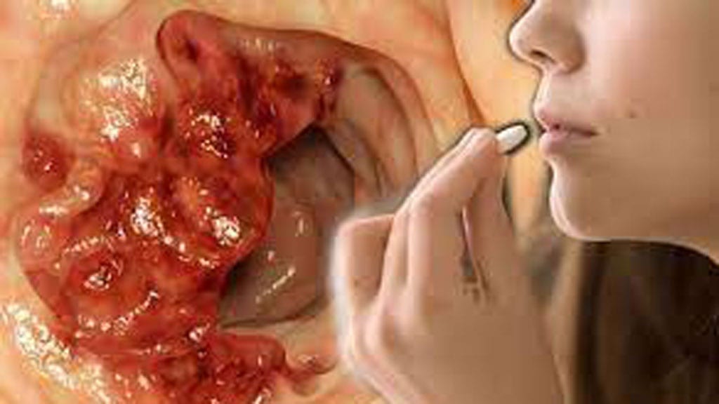 Các chuyên gia đã cảnh báo việc sử dụng kháng sinh có thể làm tăng nguy cơ ung thư ruột /// Ảnh minh họa: Shutterstock