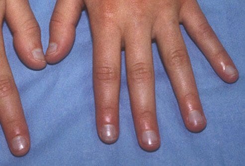 Móng tay màu tím có thể là một triệu chứng của các bệnh về phổi /// Shutterstock