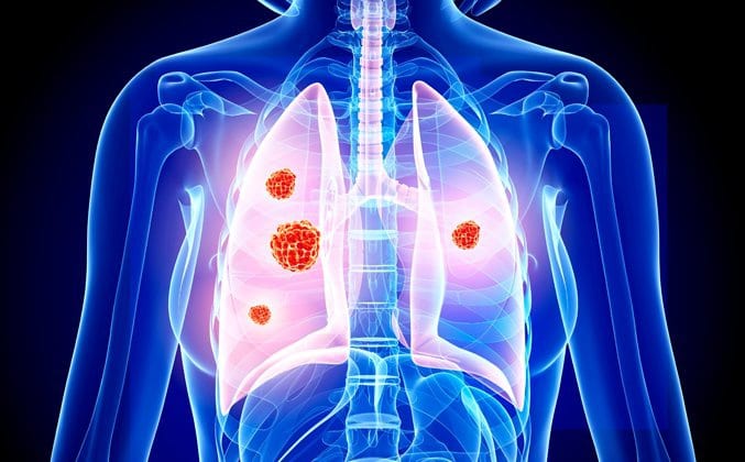 Đi khám ngay nếu gặp các triệu chứng của ung thư phổi /// Shutterstock