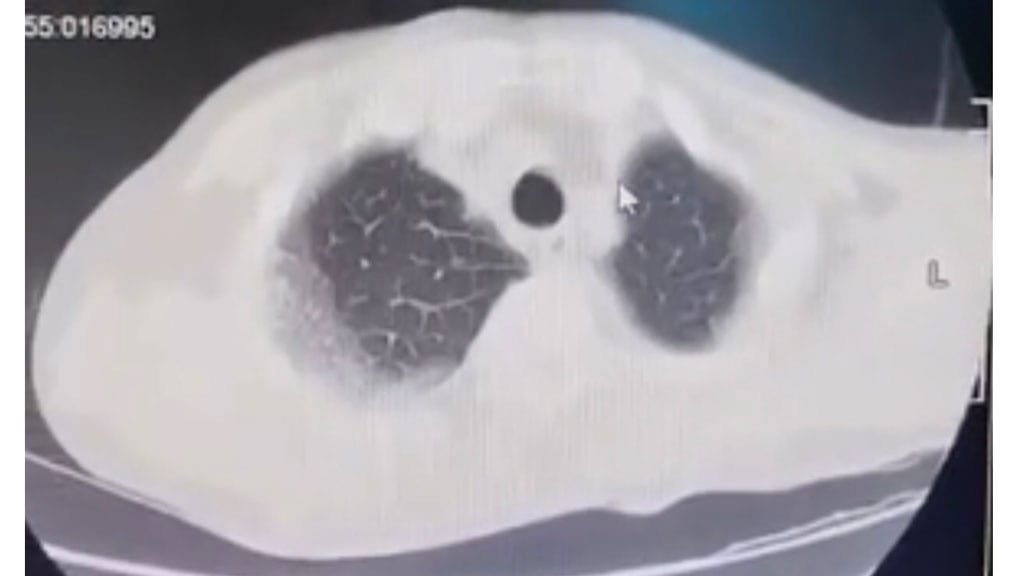 Hình ảnh phổi trắng xóa của một bệnh nhân Covid-19 tại Việt Nam /// TH.THẠCH