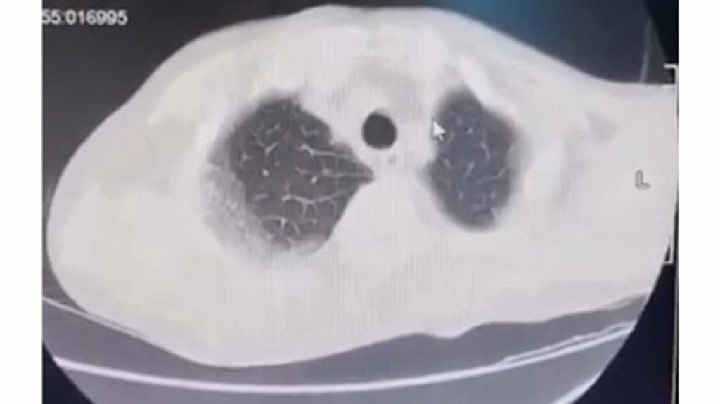 Hình ảnh bệnh nhân có phổi bị tổn thương rộng do mắc Covid-19 /// ẢNH TH.THẠCH