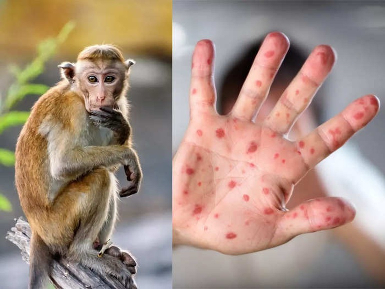 Bộ Y tế khuyến cáo: 6 việc cần làm ngay để phòng bệnh đậu mùa khỉ - 1