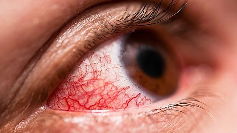 Virus gây xuất huyết ở mắt lan đến châu Âu, tỷ lệ tử vong đến 40% - ảnh 1