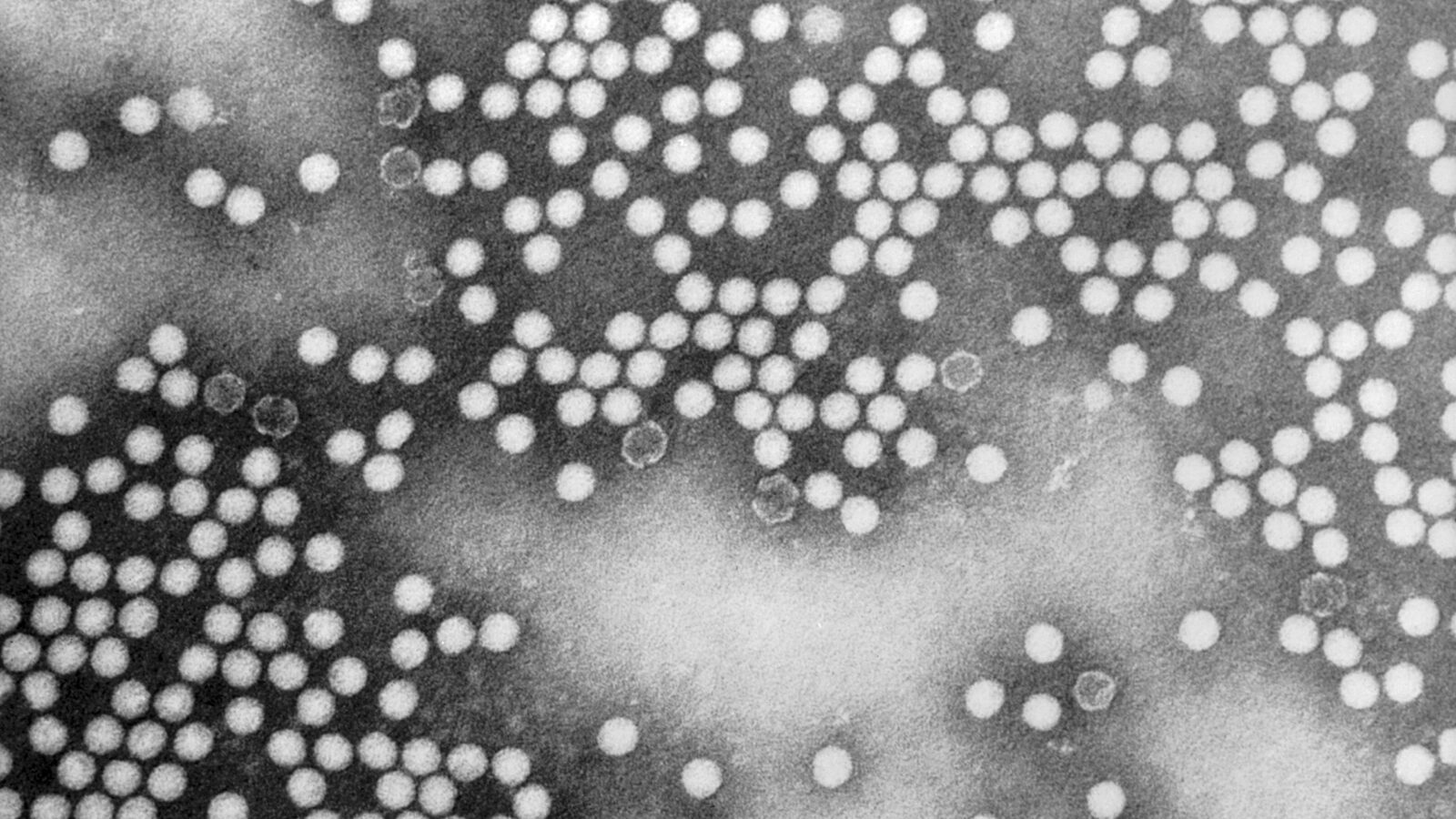 Mỹ ghi nhận ca bệnh bại liệt đầu tiên trong gần một thập niên - ảnh 1