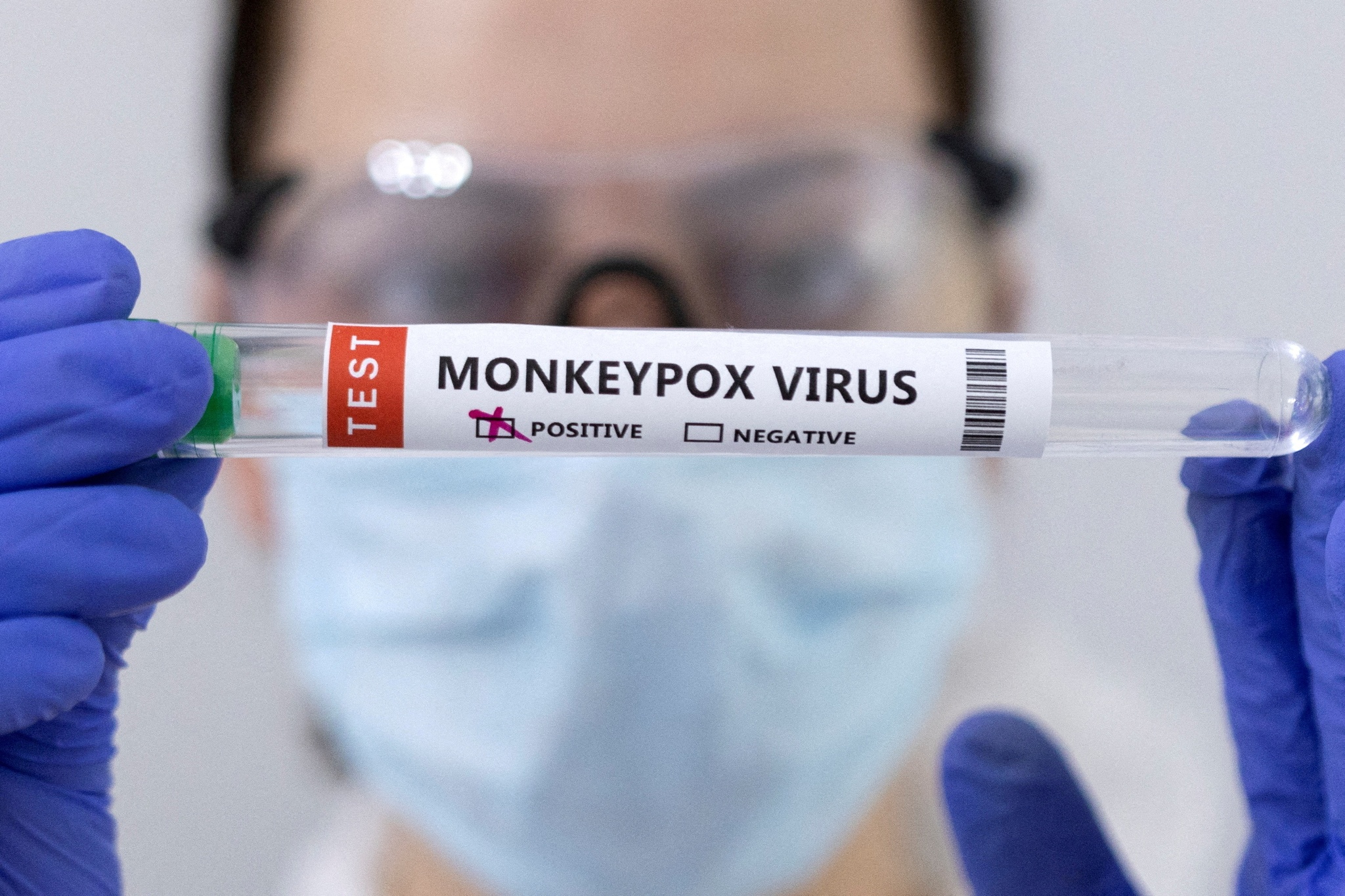 Mỹ ghi nhận ca tử vong đầu tiên liên quan bệnh đậu mùa khỉ - ảnh 1
