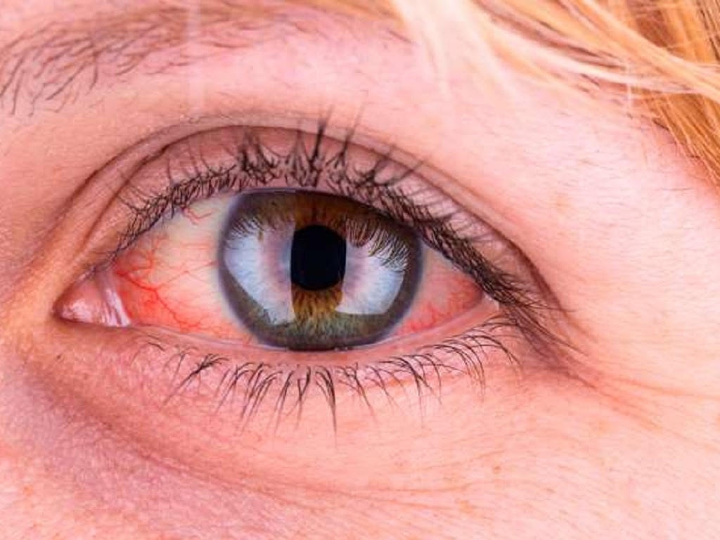 5 nguyên nhân phổ biến khiến bạn bị mắt đỏ - ảnh 1