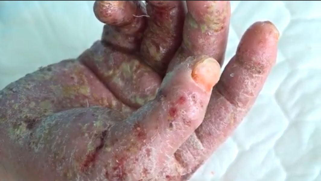 Chích vỡ mụn nước ở lòng bàn tay, bệnh nhân bị nhiễm trùng nặng - ảnh 1