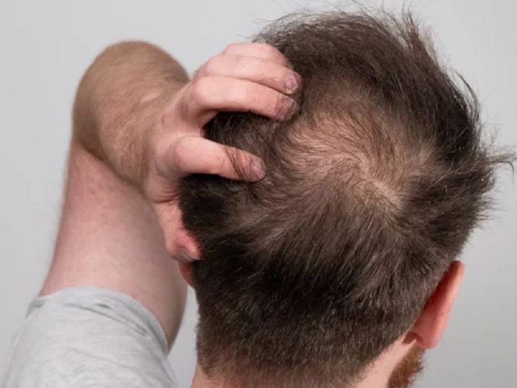 Viêm nang lông ở da đầu, làm sao để trị? - ảnh 1